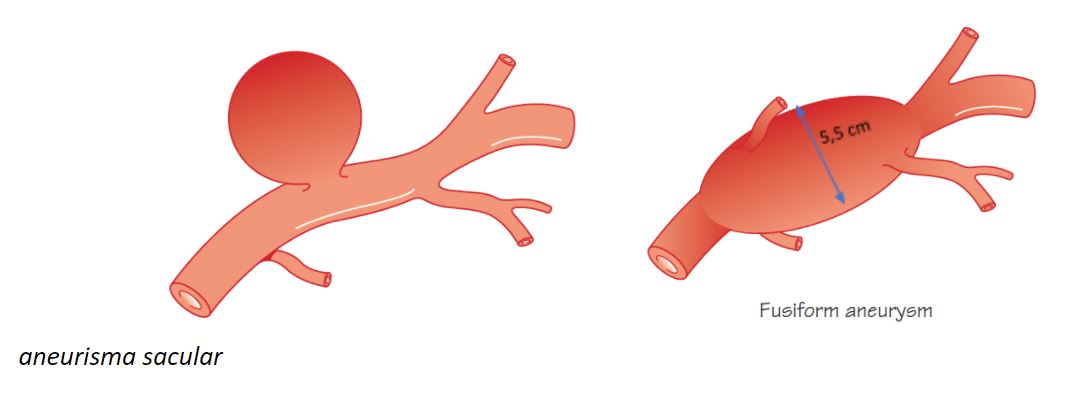 Aneurisma da Aorta Abdominal – Médica Vascular | Especialista em ...